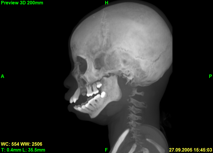 Screenshot of sagittal slice in Preview3D rendering mode